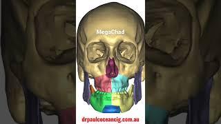 Mega chad jaw surgery animation