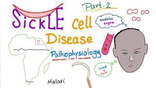 Sickle Cell Disease “part 2” ; Pathophysiology