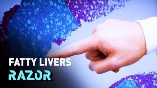 Fighting the fatty liver crisis - #RAZOR