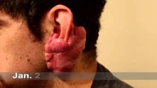 Keloid Treatment