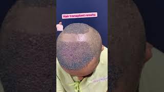  Hair Transplantation Result Before And After  #shorts