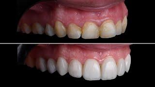 Trước và sau dán sứ Veneer #smiledesign #dental #nhakhoa