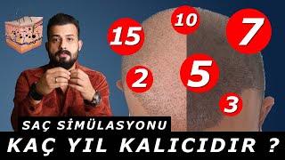 Saç simülasyonu ne kadar kalıcı ? Geçici mi ? Ömrü ne kadar ? Uzm.Est.Semih Deniz