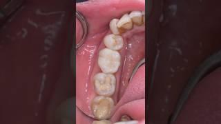 Same-day inlay or almost onlay restoration on an endo treated tooth #biomimetic #dentistry #dentist