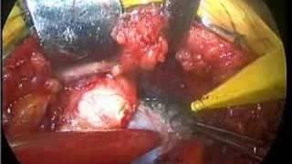 Dr.Thomas Gross-Hip Resurfacing-2006-Part 5