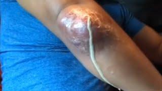 Popping huge blackheads and Giant Pimples - Best Pimple Popping Videos #165