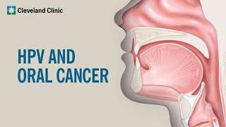 What Is HPV-Related Oral Cancer?