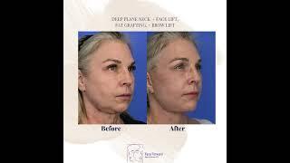 Deep Plane Face & Neck Lift Results