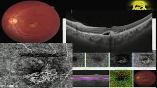 AIOC2018 - IC208 - Traps and Hazards of Newer Retinal Diagnostics