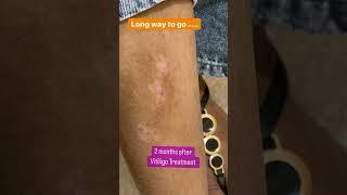 Vitiligo Treatment in Chandigarh| Dermatologistinchandigarh chandigarh #shorts