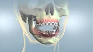 YORK ORTHODONTICS. Orthognathic Surgery Open Bite