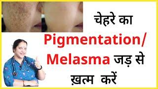 चेहरे की झाइयां ख़त्म करने का तरीका | pigmentation treatment on face | Melasma treatment