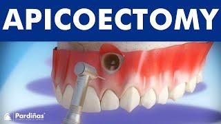 Apicoectomy - Treatment of root canal infection ©