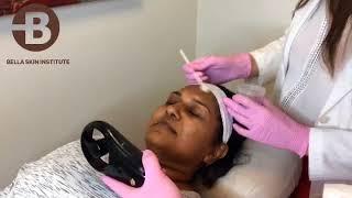 JESSNER'S PEEL for Pigment Correction by Dr. Anna Guanche