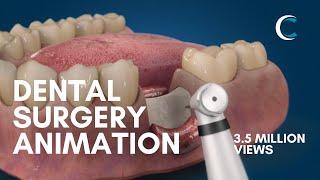 Dental Surgery Animation - Bone Grafting