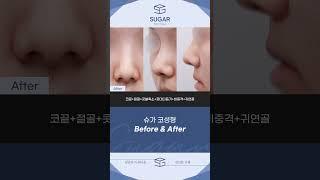 무보형물 코성형 수술 후 1개월 변화 ️