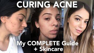 CURING ACNE: My COMPLETE Guide + Skincare