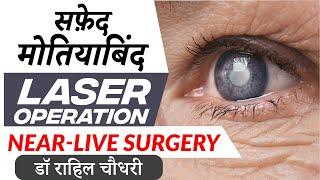 लेज़र से मोतियाबिंद का इलाज | Near Live Laser Cataract Surgery | No Blade, No Pain, No Injection