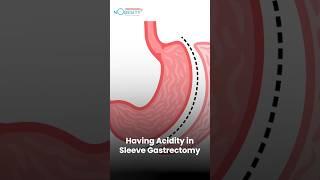 Bariatric Surgery Risks and Complications Explained by Dr. Manish Khaitan | NObesity
