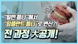 [임플란트틀니] 일반틀니에서 임플란트 틀니로 변신 과정 대공개!