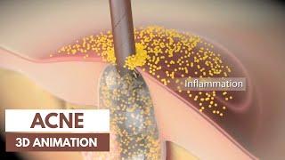 Acne basics | Pathophysiology & Treatment  | 3D Animation