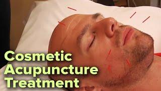 Relaxing Cosmetic Facial Acupuncture Treatment | Enhances Skin Tone and Reduces Wrinkles