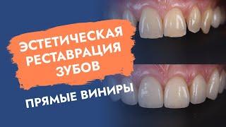 Эстетическая реставрация зубов: прямые виниры!