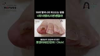 90대 할머니를 괴롭힌 파고드는 발톱! 너무 아팠어.. 이제 괜찮아^^ #레푸스 #일산레푸스 #내성발톱 #무좀발톱 #ingrown_toenail #일산내성발톱 #일산무좀발톱 #발톱