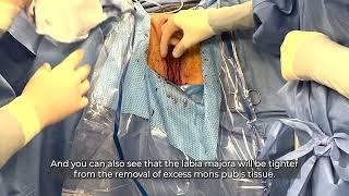 ALVR Procedures: Monsplasty and Labia Majora Reduction Surgery