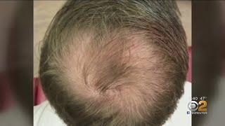 Can PRP Injections Spark Hair Growth?