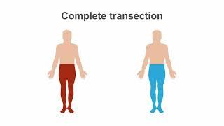 Spinal Cord Syndromes: Clinical Recognition & Anatomy Review