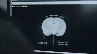 Musk’s Neuralink: First Patient Receives Brain Implant