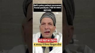 चेहरे का लकवा हुआ ठीक वो भी चार सप्ताह के दौरान #sleepparalysis #paralysis #लकवा