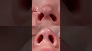 Dr. Saman's Scarless Endonasal Rhinoplasty Explained #nosesurgery #cosmeticsurgeon #medicaleducation