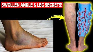 Edema: Swollen Feet, Swollen Ankles & Swollen Legs [FIX Them FAST!]