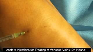 Varicose Vein Removal with Asclera Injections - Veins are gone!