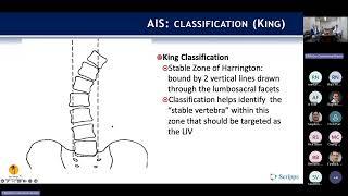 Adolescent Idiopathic Scoliosis : Nikita Lakomkin, MD