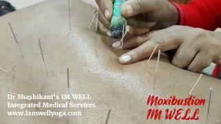 Medical Acupuncture and Moxibustion Dr Shashikant #Moxa #Moxibustion #Medical #Acupuncture