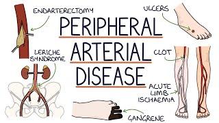 Understanding Peripheral Arterial Disease