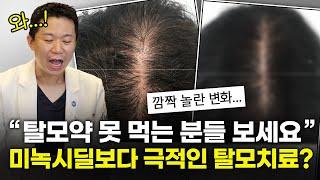 탈모약 먹지않고 정수리탈모 치료하는 방법