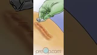 PreOp® Simplifying Wound Care: Step by Step #preop #shorts #health  #animation #doctor