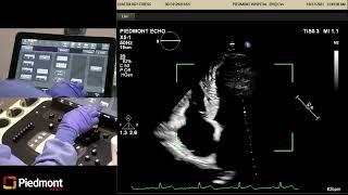 Piedmont Healthcare Stress Echo Protocol on the Philips Epic