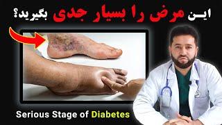 مراحل جدی مرض شکر چیست و حرکت کم باعث دیابت میشود؟  Serious Diabetes Stages Cause of Less Movements