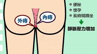 如何看懂大腸鏡檢查報告 B 動畫 4