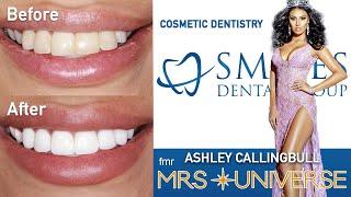 Cosmetic Dentistry - Smile Transformation with Veneers & Crowns