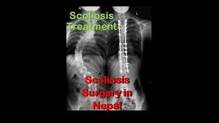 Scoliosis Surgery in Nepal. #scoliosis #surgery #scoliosistreatment #spinesurgery #spine #treatment