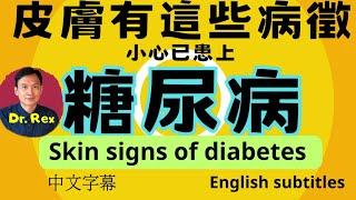 ￼留意這些糖尿病的皮膚徵狀！skin signs of diabetes