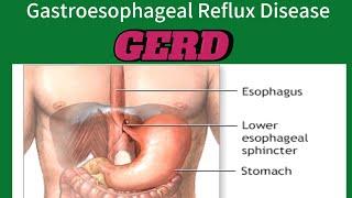 WHAT CAUSES GERD.