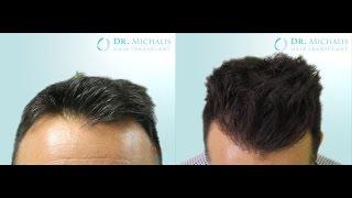 2921 Grafts FUE Hair Transplant unshaven respectively without shaving head/recipient area