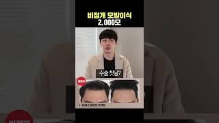 [비절개모발이식 후기] 이제 포마드 스타일하러 갑니다. (2000모 이식)